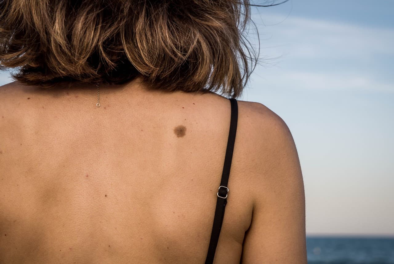 Mole Changes After Summer Header