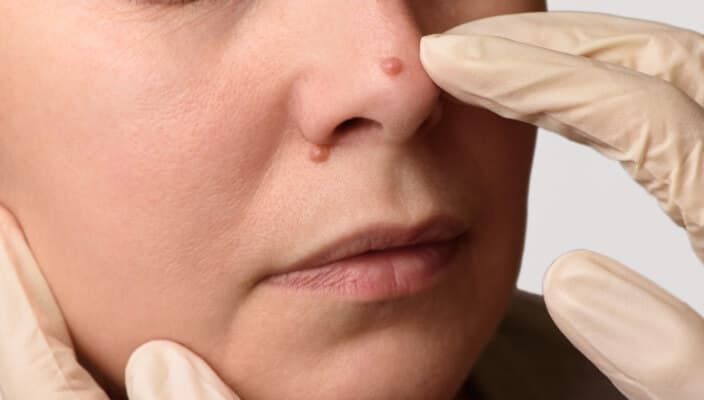 Tru-Skin Blog - Everything You Need to Know About Warts, Cold Sores, and Skin Growths in Texas