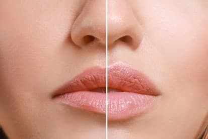 pinnacleskin.com /treatments/lip-augmentation Carousel 1 Image 9