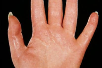 Tru-Skin Blog - Hyperhidrosis vs. Normal Sweating