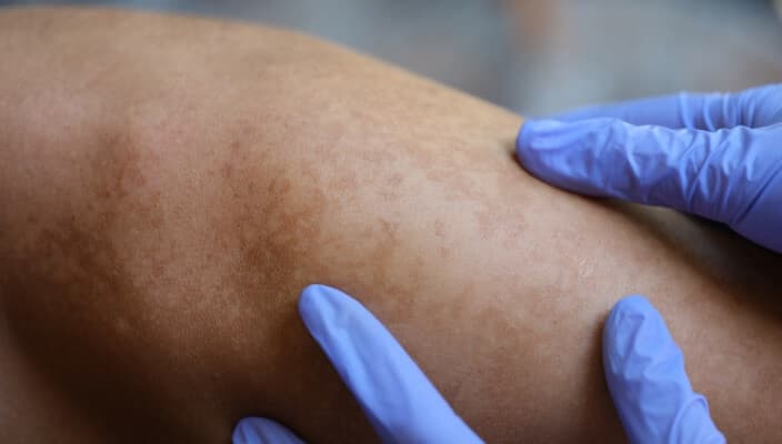 Tru-Skin Blog - Exploring the Benefits and Risks of Skin Graft Surgery: What You Need to Know
