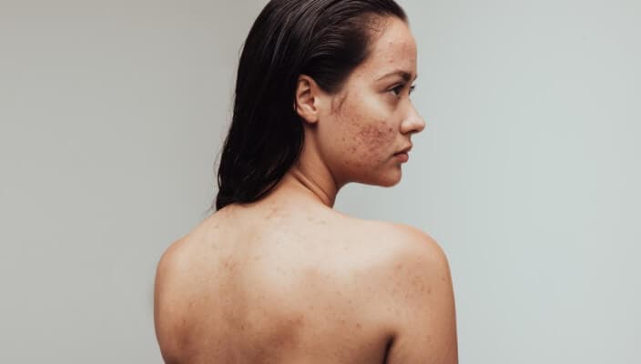Tru-Skin Blog - Understanding and Treating Different Types of Acne