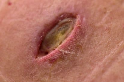 pinnacleskin.com /treatments/standard-excision Carousel 1 Image 2