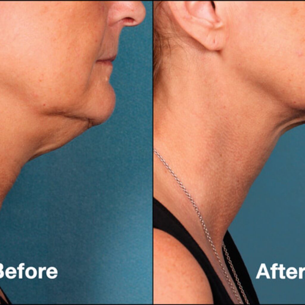 Kybella Non-surgical Skin Treatment in Kerrville, TX