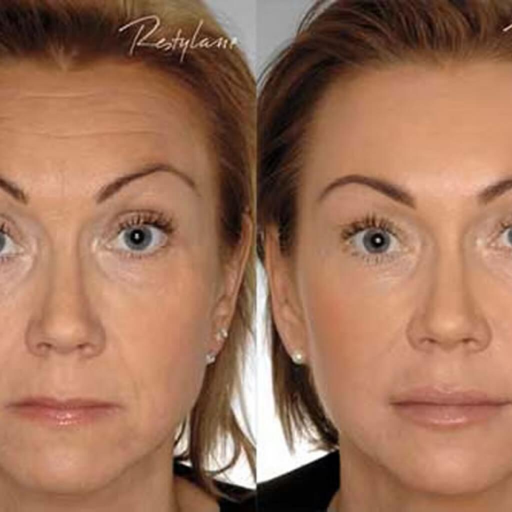 Before/After Restylane®