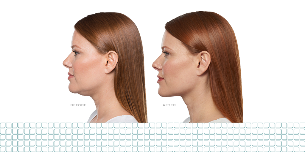 5 Things to Know About Kybella®