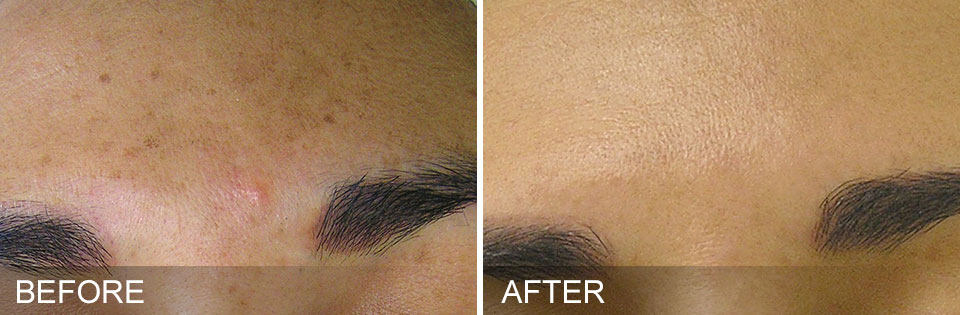 Brown spots before and after