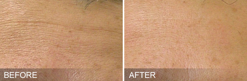 Fine Lines before and after HydraFacial