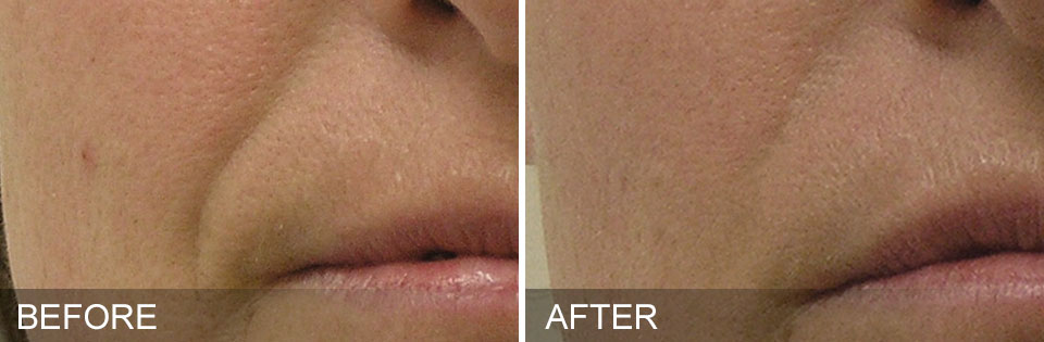 Nasolabial Folds Before and After