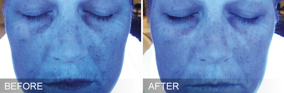 Facial Hydration before and after